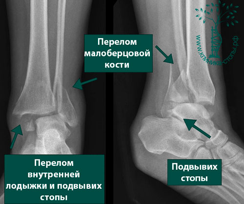 Реферат: Лечение переломов лодыжек с отрывом заднего нижнего края большеберцовой кости